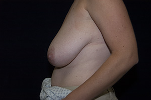 Mastopexy 2c